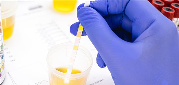 Ketonkörper im Urin zu messen und zu beurteilen kann schwierig sein.
