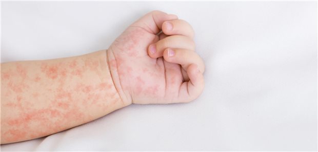 Kind mit Masern: Im US-Bundesstaat Texas gibt es seit mehreren Wochen einen Masernausbruch mit bislang 124 bestätigten Fällen. (Symbolbild)