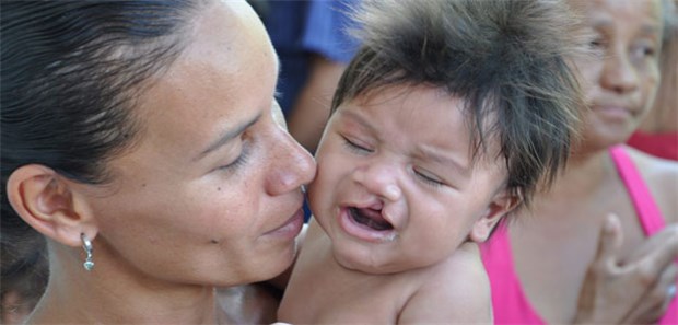 Ärzte schenken neue Hoffnung Kinder mit Lippenspalte gelten in Brasilien als Aussätzige. Die Ärzte von Interplast schenken neue Hoffnung.