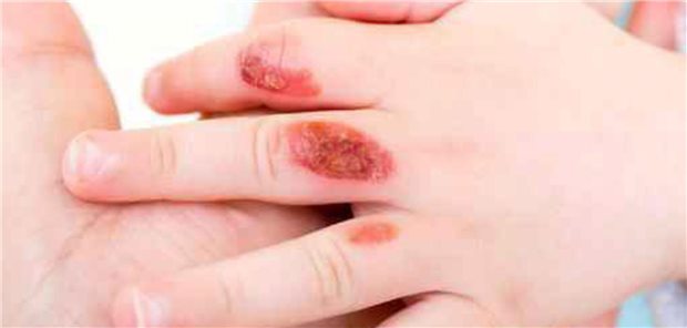 Kindliches Missgeschick beim Spielen oder Kindesmisshandlung? Vor dieser Frage stehen gerade Pädiater immer wieder in der Praxis. 