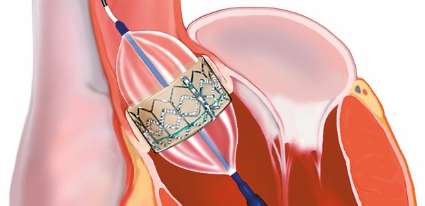 Klappe per Katheter: Erfolgversprechende Drei-Jahres-Daten vorgelegt.