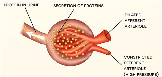 Klinisch ist die Herausforderung bei der IgA-Nephropathie ihr variabler Verlauf. In den meisten Fällen macht sie keine großen Probleme. Bei einem Teil der Patienten verläuft sie chronisch aktiv, und einige wenige erleiden katastrophale Verläufe, die anderen, schweren Glomerulonephritiden nicht nachstehen.