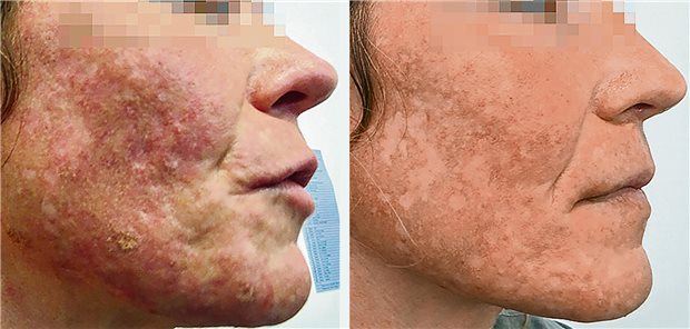 Pellagra statt Akne – Frau lebte 20 Jahre mit falscher Diagnose Klinisches Bild a) vor und b) nach erfolgter Substitutionstherapie.