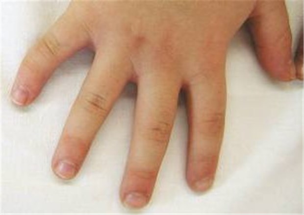 Bei Klinodaktylie ist Therapie nicht unbedingt nötig Klinodaktylie des kleinen Fingers der rechten Hand bei einem vierjährigen Jungen.