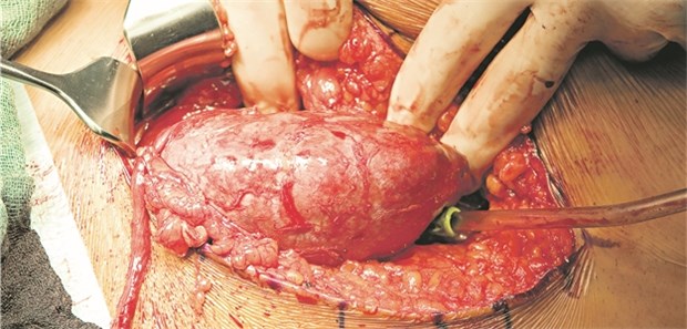 Lebendspender haben ein leicht erhöhtes Risiko, dass die verbleibende Niere versagt Knapp jede dritte transplantierte Niere in Deutschland stammt von einem Lebendspender.