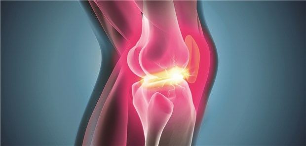 Arthrose-Patienten schwören auf IGeL Knapp vier von zehn Kniearthrose-Patienten mit Kniearthrose