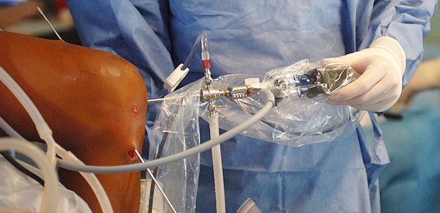 Hohe Komplikationsraten bei Knie-Arthroskopie Knie-Arthroskopie: Rekonstruktionen des hinteren Kreuzbandes führten in der US-Studie in jedem fünften Fall zu Schwierigkeiten.