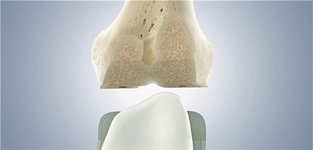 Knie-Endprothese: Wegen der oft langen NSAR-Therapie sollten Ärzte bei TEPPatienten auf gastrointestinale Probleme achten.