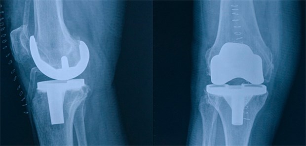 Richter billigen Mindestmenge für Knie-TEP Knie-TEP: Das Bundessozialgericht befürwortet Minedstmengen für diesen Eingriff.