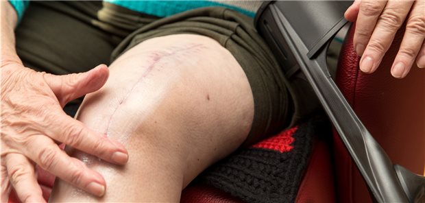 Knieendoprothese: Ob nach der Implantation ein erneuter Eingriff nötig wird, hängt von der Erfahrung des Operateurs ab, heißt es in einem IQWiG-Bericht.