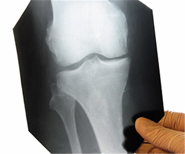 Arthrose: Erfolg mit Knorpel-Knochen-Transplantation Kniegelenk im Blick: Bei Arthrose hann die Transplantation autologer Chrondrozyten helfen.