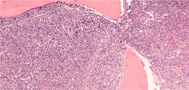 Knochenmarkinfiltration bei DLBCL.  David A Litman / stock.adobe.com