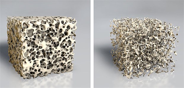 Knochenveränderung durch Opstopoose (rechts). Insgesamt wurde bei etwa 3 Millionen Frauen und 0,63 Millionen Männern eine Osteoporose diagnostiziert (Zahlen aus 2016).