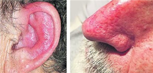 Knorpelbeteilung beim VEXAS-Syndrom: Links eine aurikuläre Chondritis, rechts eine nasale Chondritis, die beim dokumentierten Fall manchmal mit einer periorbitalen Inflammation einhergingen.&#xA;