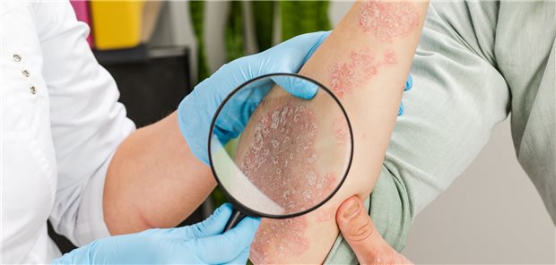 Könnte ein beruflicher Zusammenhang mit der Dermatose bestehen? Dann müssen Ärzte eine Verdachtsanzeige beim zuständigen Unfallversicherungsträger des Patienten stellen.