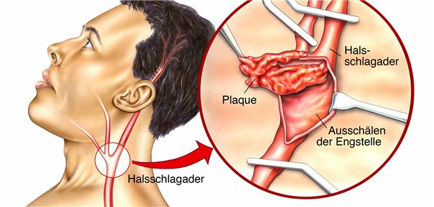 Könnten Schlaganfall-Patienten mit „komplizierten“ Karotis-Plaques von einer operativen Entfernung nicht-stenotischer Risikoplaques prognostisch profitieren, so wie das bei Patienten mit hochgradig verengten Läsionen der Fall ist?