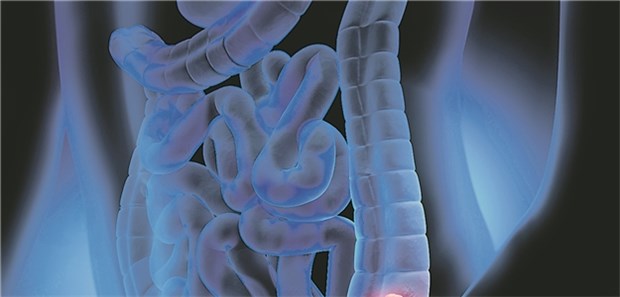 Begleiterkrankungen verzögern die Diagnose Kolon-Ca: Besonders eine gleichzeitig vorliegende chronisch entzündliche Darmerkrankung kann die Diagnose verzögern.