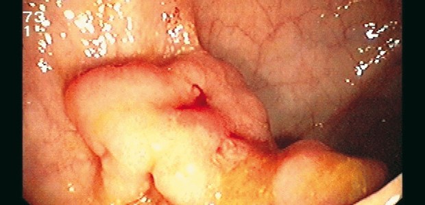 Ist der Anstieg der Krebsinzidenz gestoppt? Kolon-Ca in situ: Das RKI spricht von Erfolgen bei der Darmkrebsinzidenz.