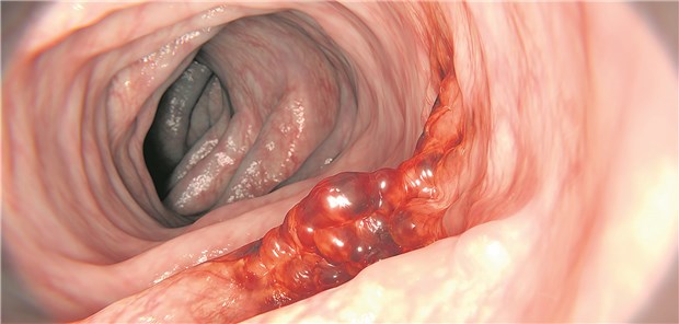 Kolonkarzinom: Ob es metastasiert, hängt von der Aktivität der Gene Tp53 und Mir34a ab.