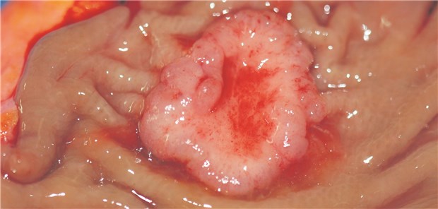 Kolonkarzinom am aufgeschnittenen Kolon.