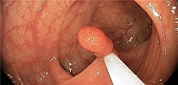 Kolonpolypen: Im Bezug auf das Risiko von Blutungen nach einer Ektomie gibt es Unterschiede zwischen den Wirkstoffen.