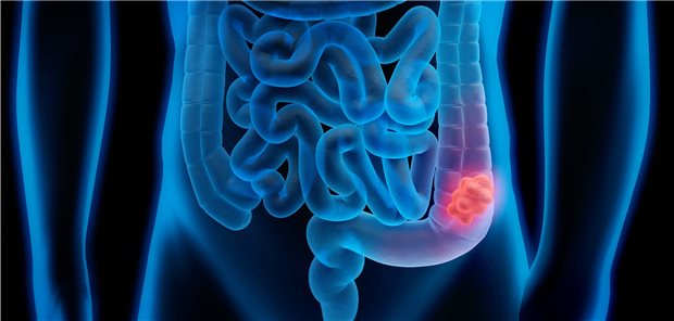 Kolorektales Karzinom: Auf die Entstehung von Darmkrebs wirken sich die unterschiedlichen Hormon-Ausstattungen von Männer und Frauen offenbar stärker aus als bisher angenommen.