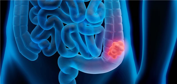 Kolorektales Karzinom: Diese Krebserkrankung findet sich besonders häufig bei Patienten mit Diabetes oder Adipositas.