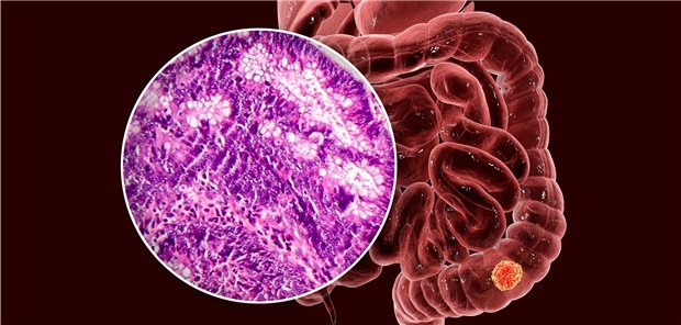 Kolorektales Karzinom: Welche neuen Erkenntnisse zu Prävention und Therapie gibt es?