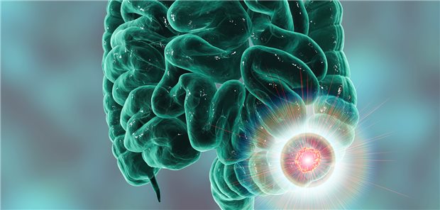 Kolorektales Karzinom: Welchen Einfluss ein positiver ctDNA-Test auf das Rezidivrisiko bei Darmkrebs hat, hat ein Forschungsteam nun untersucht.