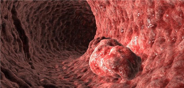 Abbildung des Darms mit Darmkrebs