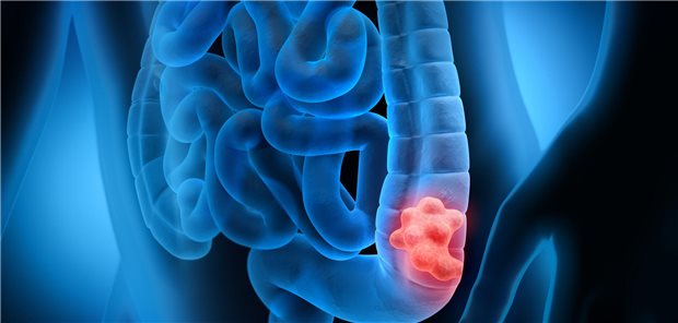 3D-Darstellung eines Tumors im Colon (Symbolbild).