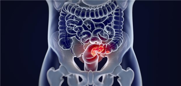 Kolorektalkarzinom: Für Patienten im metastasierten Stadium könnte Fruquintinib ist eine weitere Option sein.