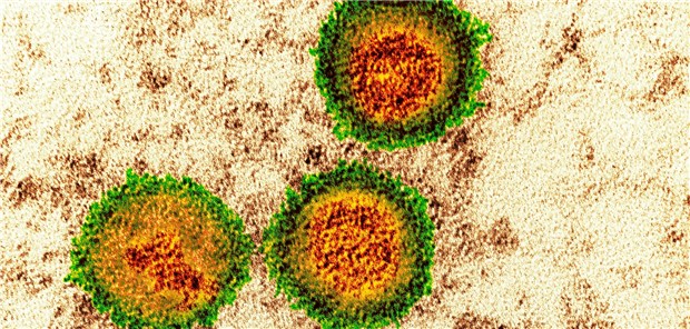 Kolorierte Elektronenmikroskopie-Aufnahme von Epstein-Barr-Viruspartikeln.