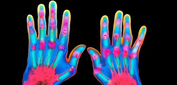 Koloriertes Röntgenbild bei Arthritis: Rosa-Färbung deutet auf angeschwollene und deformierte Fingergelenke.