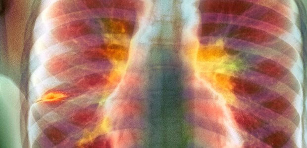 Einige Erfolge - und viele Probleme Koloriertes Röntgenbild eines 14-jährigen Jungen mit Tuberkuolose: Hervorgehoben sind die entzündeten Lymphknoten (Lymphadenopathie, gelb) und die Flüssigkeit im Lappenspalt rechts (orange).