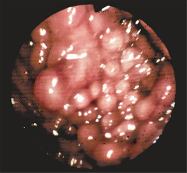 Mit Mesalazin kommen Colitis-Kranke meist gut hin Koloskopisches Bild der Darmschleimhaut mit Pseudopolypen bei Colitis ulcerosa.