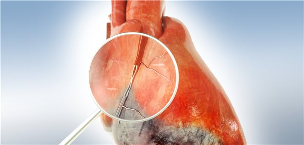 Kommt bei Infarktpatienten noch eine subklinische Hypothyreose hinzu, verschlechtert sich die Prognose deutlich.