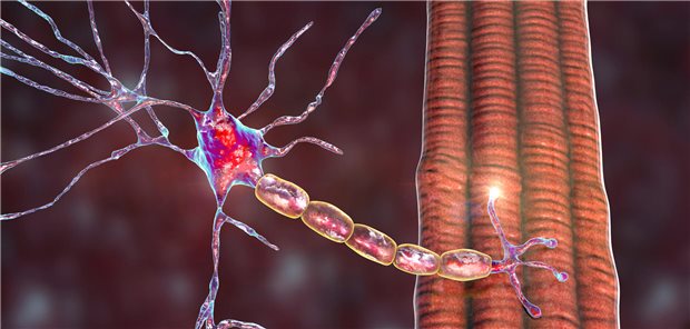 Erfolg mit CAR-T-Zell-Therapie bei refraktärer Myasthenia gravis Kommunikation von Nerv und Muskel im Fokus: Bei einer Patientin mit therapierefraktärer Myasthenia gravis führte eine CAR-T-Zell-Therapie zu einer deutlichen klinischen Besserung, selbstständiges Gehen wurde wieder möglich, und die Vitalkapazität der Lunge verbesserte sich.