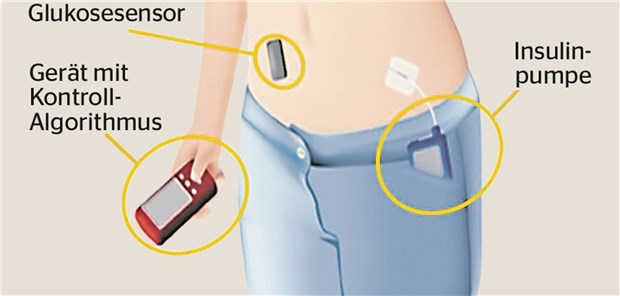 Künstliches Pankreas bewährt sich bei Diabetes in der Klinik Komponenten des künstlichen Pankreas: Die Pumpe gibt automatisch nach einem Algorithmus das Insulin ab.
