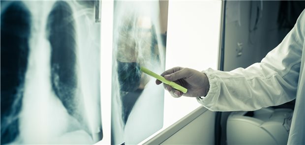 Kontrolle des Lungenbefundes. Forscher testen derzeit die Möglichkeiten der Therapie mit dem Darm-Hormon VIP bei Lungenkrankheiten.