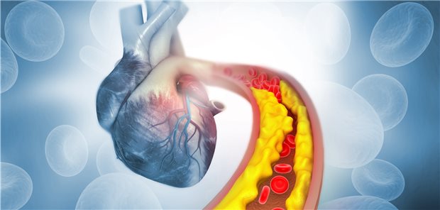Herz-Bypässe aus dem Biodrucker Koronararterienstenose: Bei etwa 20 Prozent der Patienten, die eine Bypass-Operation benötigen, sind keine geeigneten körpereigenen Gefäße vorhanden.