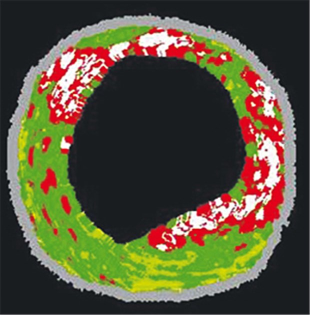 "HDL haben gefäßprotektive Eigenschaften" Koronare Plaque im Radiofrequenz-Ultraschall: nekrotisches (rot), fibrotisches (grün) und kalkhaltiges (weiß) Gewebe.