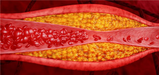 Darstellung eines Koronarplaques