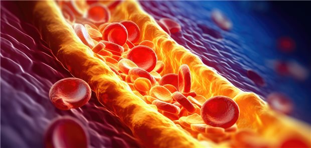 Koronarstenose: Deutliche Vorteile für Betroffene bietet die Computertomografie-Koronarangiografie wohl als Ersatz für andere Testverfahren auf chronische KHK und zur Entscheidung über den Einsatz invasiverer Verfahren.