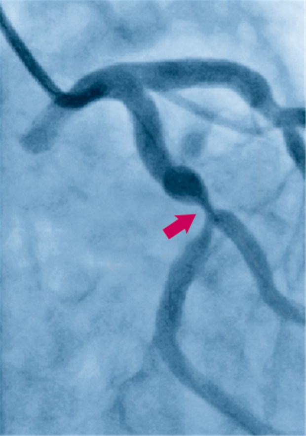 Koronarstenose (Pfeil) in der Angiografie. Zu bedenken ist, dass auch rheumatische Erkrankungen arterielle Stenosen verursachen können, die aber nicht Ausdruck einer Atherosklerose sind. © Siemens Medical Solutions