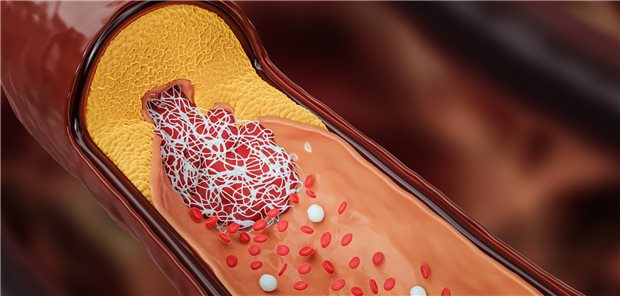 Koronarstenose: Welches quantitative Bildgebungsverfahren ist für welche Patientinnen und Patienten mit KHK am besten geeignet?
