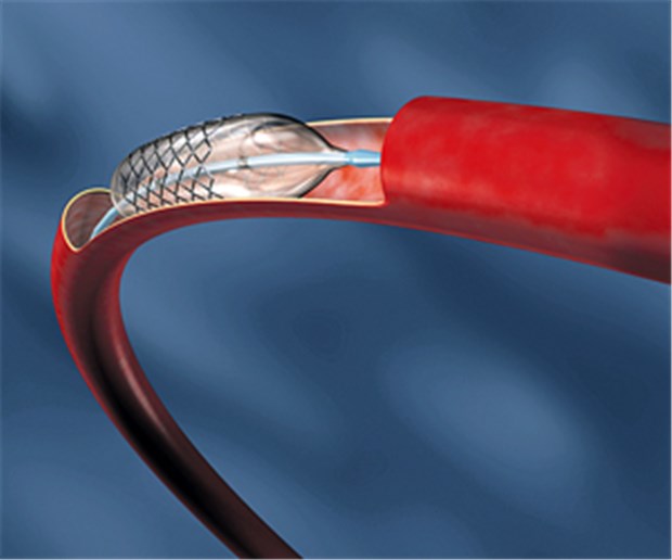 Koronarstents haben die KHK-Therapie revolutioniert.