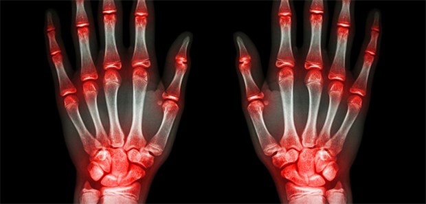 Kortikosteroide könnten laut Forschern eine Alternative zu NSAR bei akuter Gicht sein.