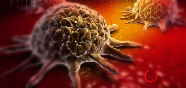 Krebs: In Ländern mit früher Implementation von Darmkrebsfrüherkennungsprogramme ist die Mortalität am stärksten gesunken.