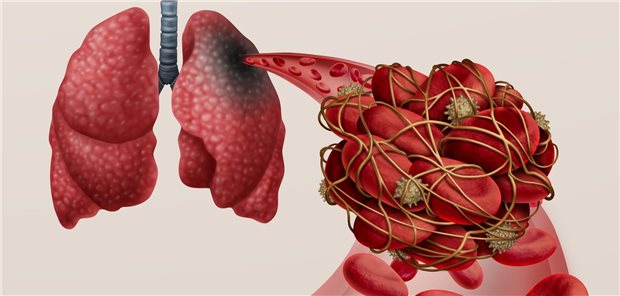 Lungenembolie mit einem Blutgerinnsel als Erkrankung mit Verstopfung einer Arterie in der Lunge mit 3D-Darstellungselementen.